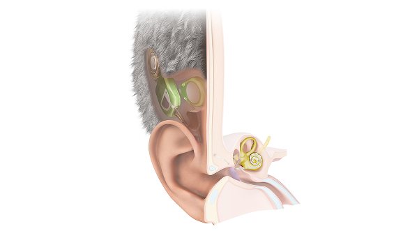 Ilustração anatômica do TICI implantado sob a pele, com componentes internos conectados à cóclea, representando um implante coclear invisível e totalmente implantável.